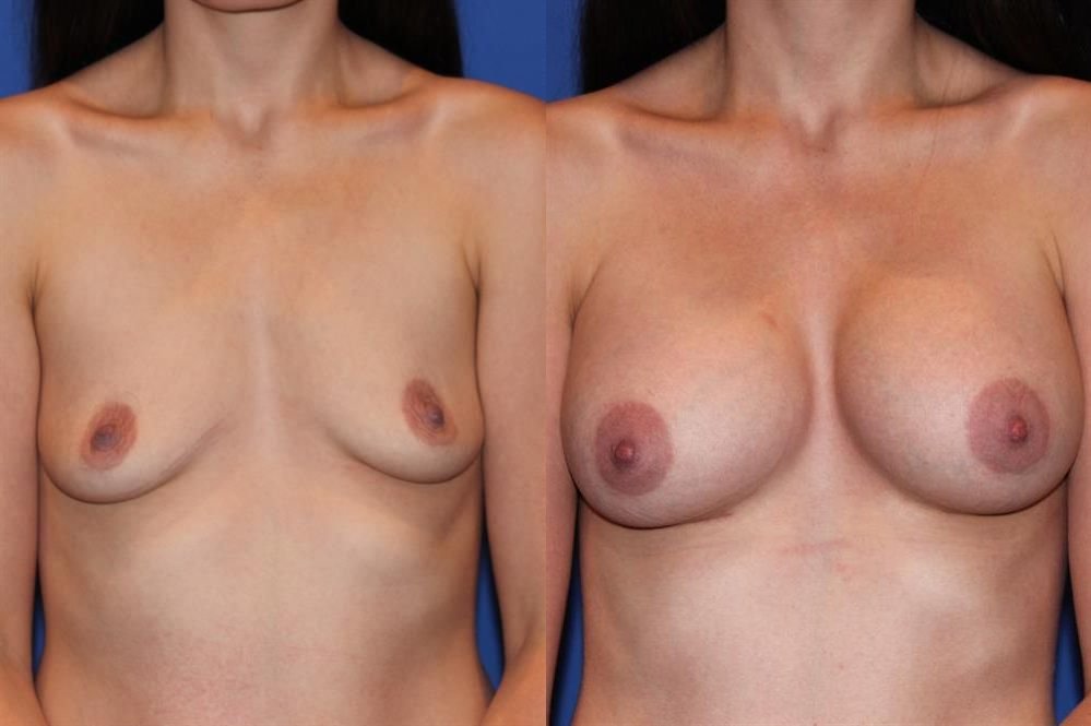 Breast Augmentation 271