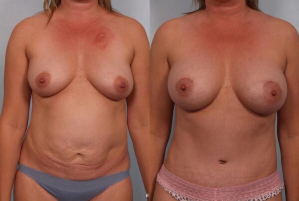 Breast Augmentation 272