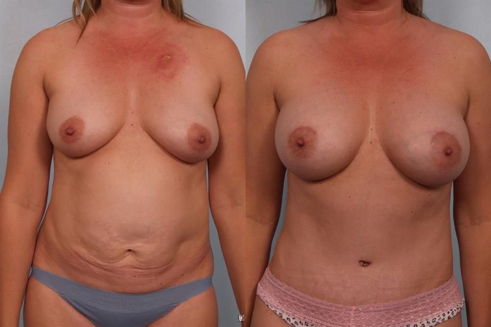 Breast Augmentation 272