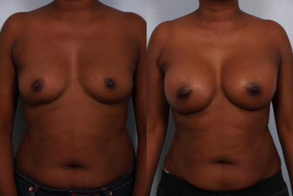 Breast Augmentation 273