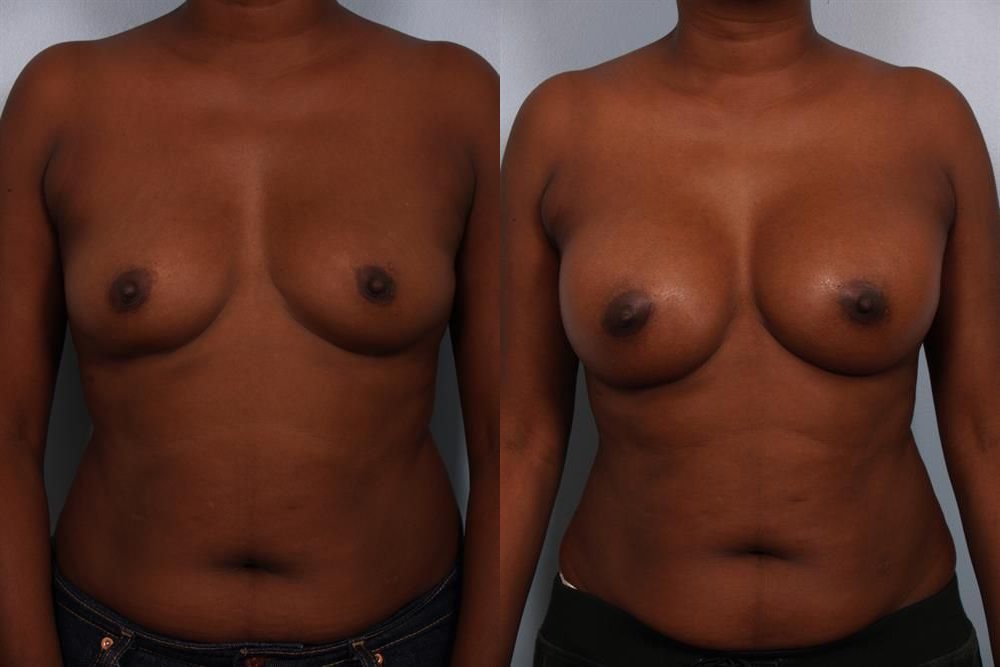 Breast Augmentation 273