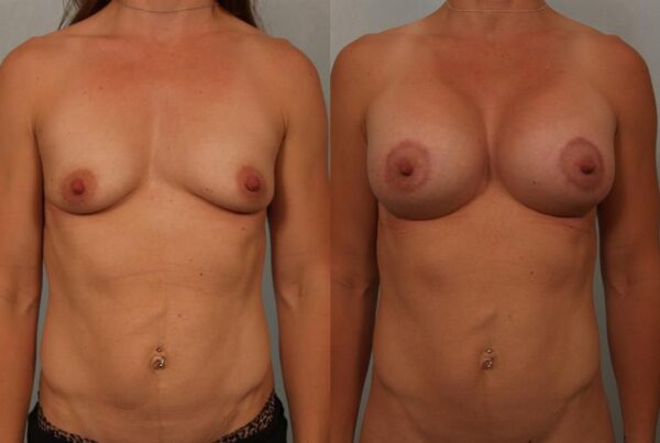 Breast Augmentation 274