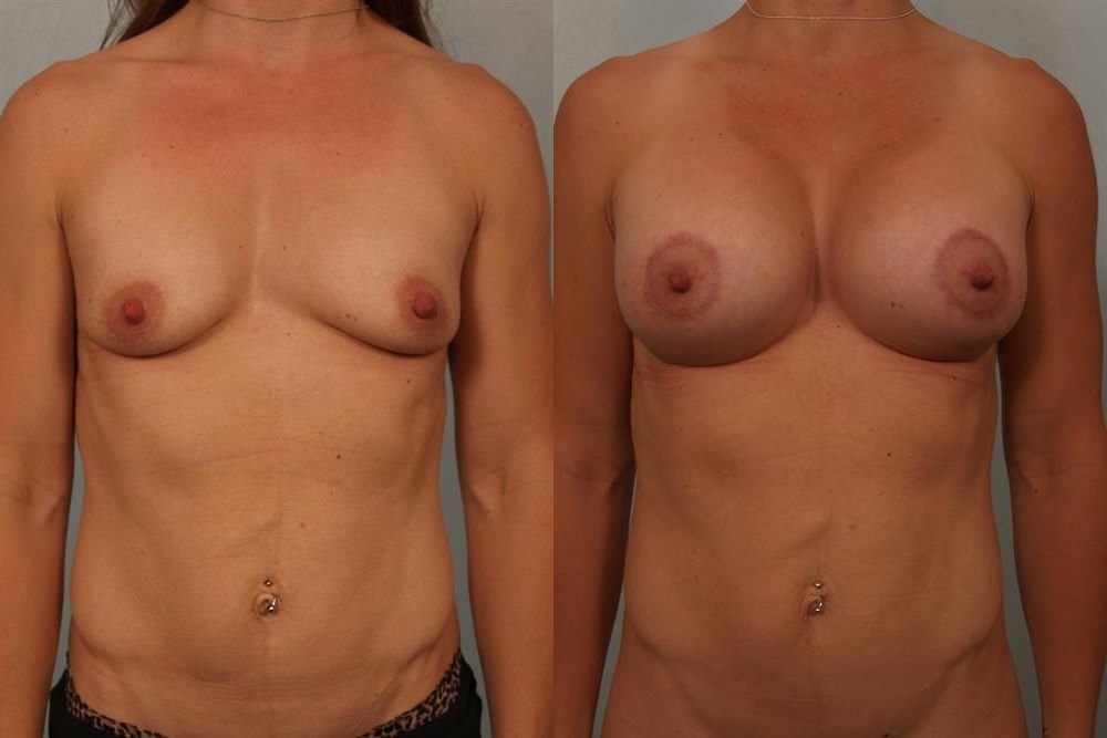 Breast Augmentation 274
