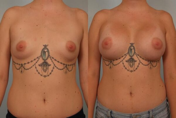 Breast Augmentation 275
