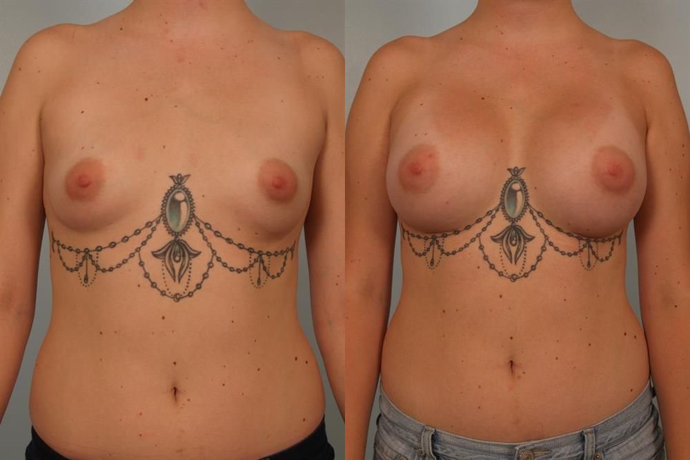 Breast Augmentation 275