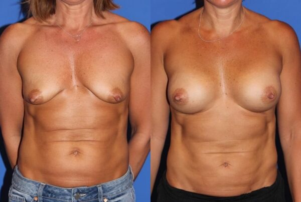Breast Augmentation 276