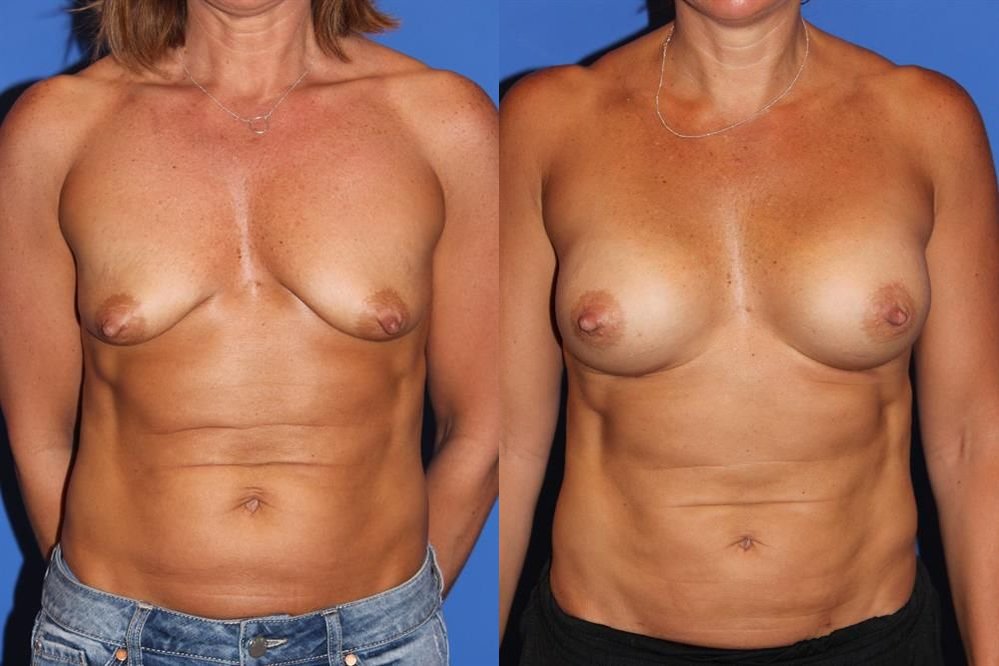 Breast Augmentation 276