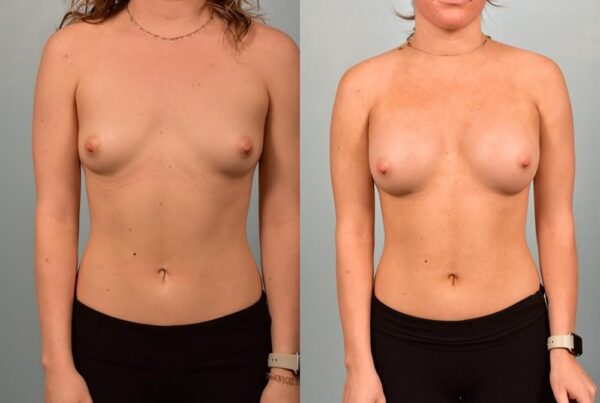 Breast Augmentation 278