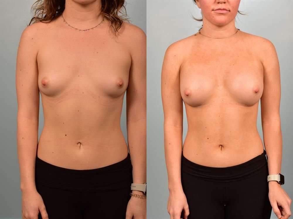 Breast Augmentation 278