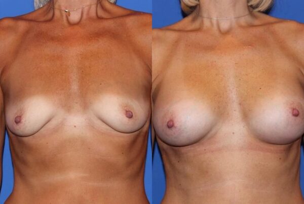 Breast Augmentation 279