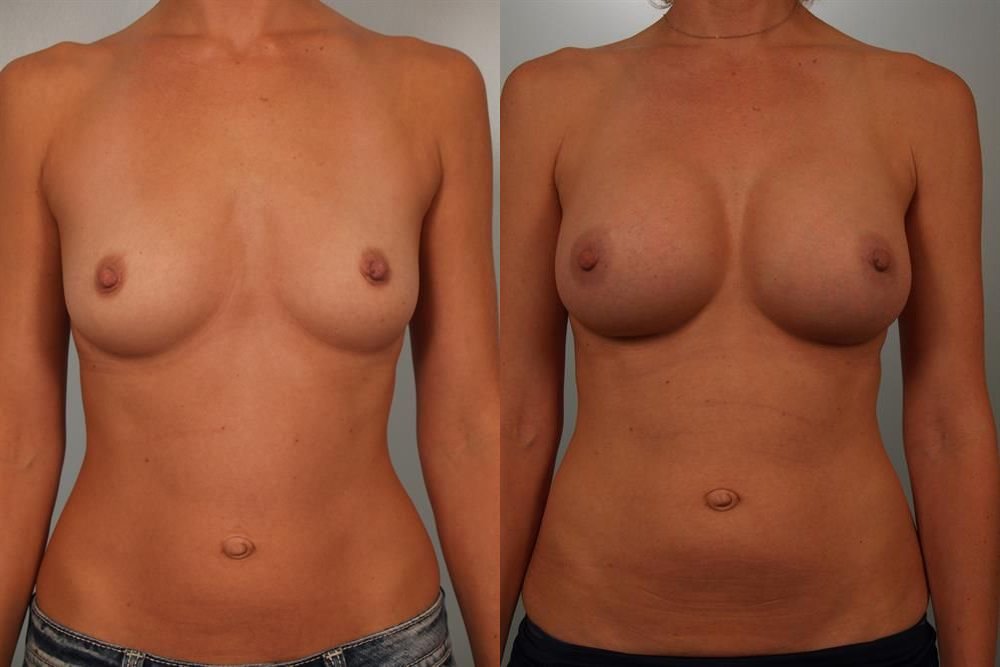 Breast Augmentation 28