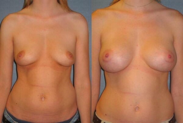 Breast Augmentation 280