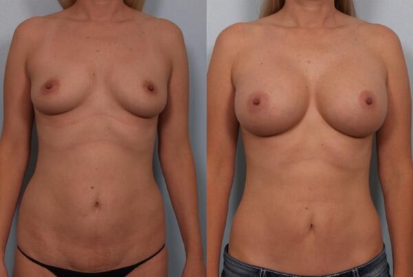 Breast Augmentation 281