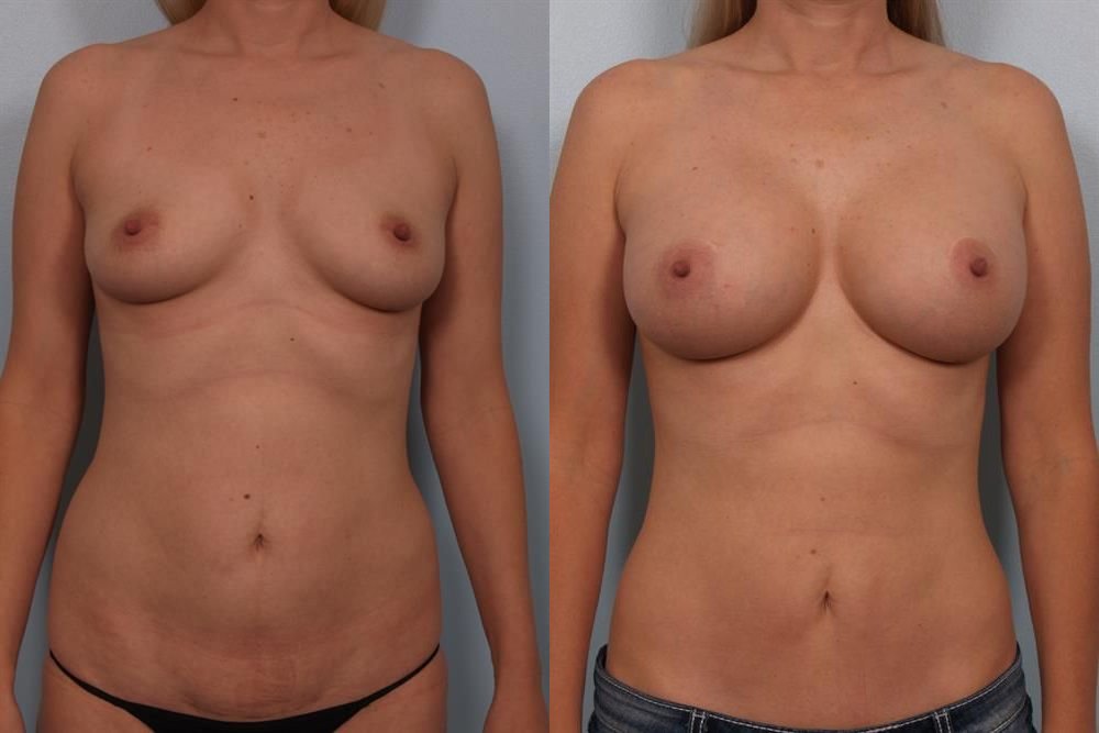 Breast Augmentation 281