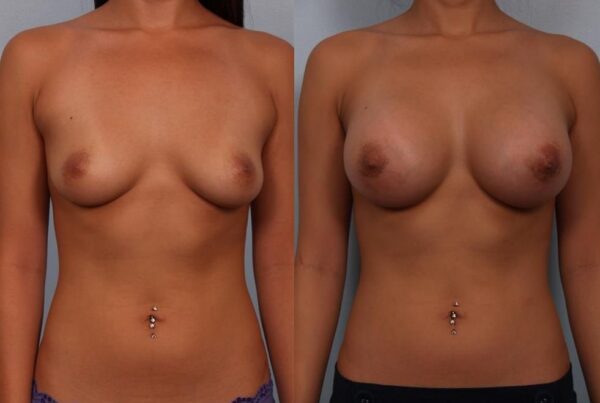 Breast Augmentation 282