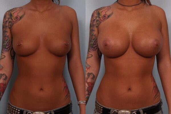 Breast Augmentation 283