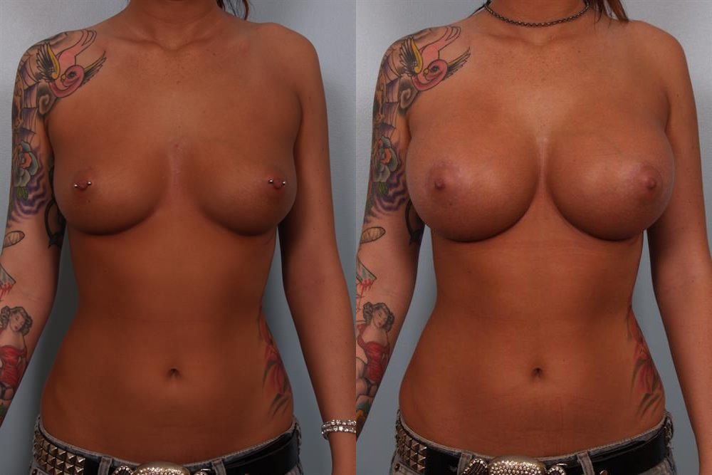 Breast Augmentation 283