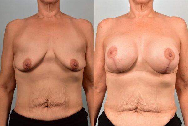 Breast Augmentation 284