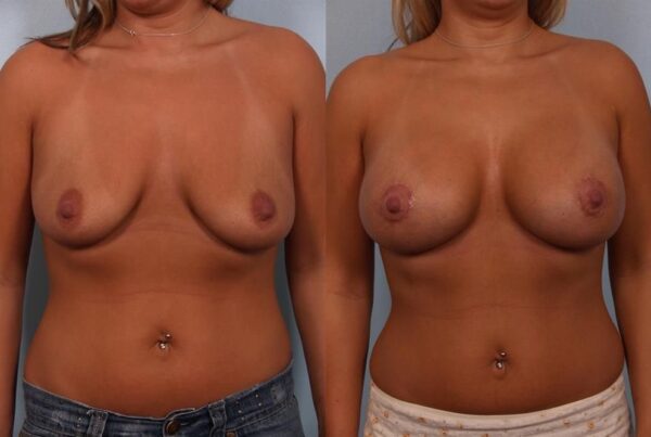 Breast Augmentation 285