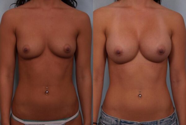 Breast Augmentation 286