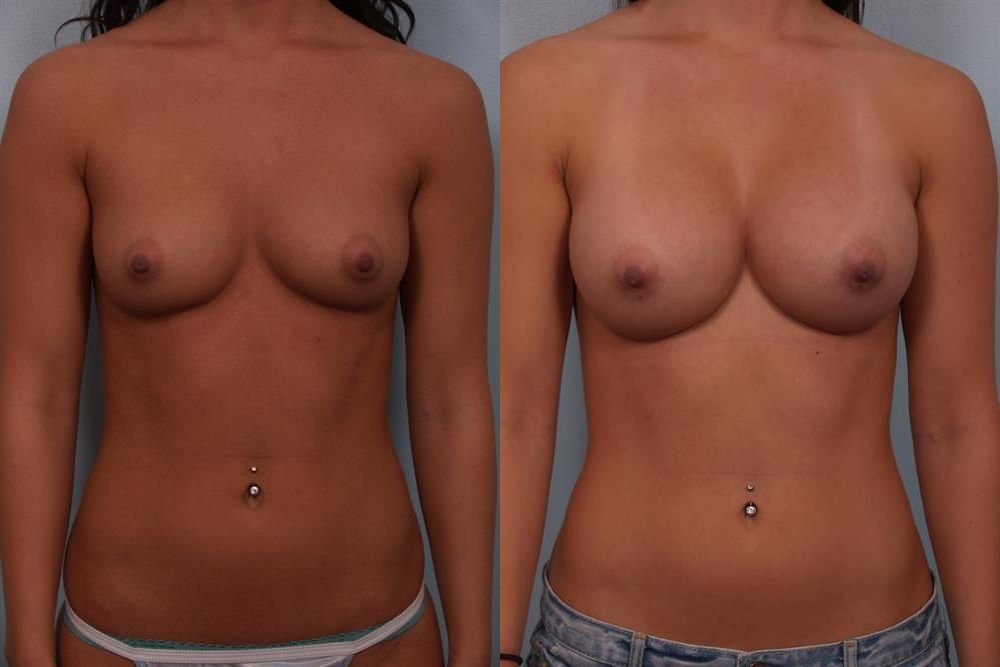 Breast Augmentation 286