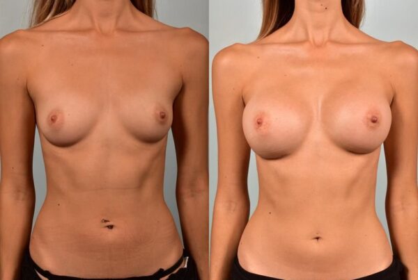 Breast Augmentation 287