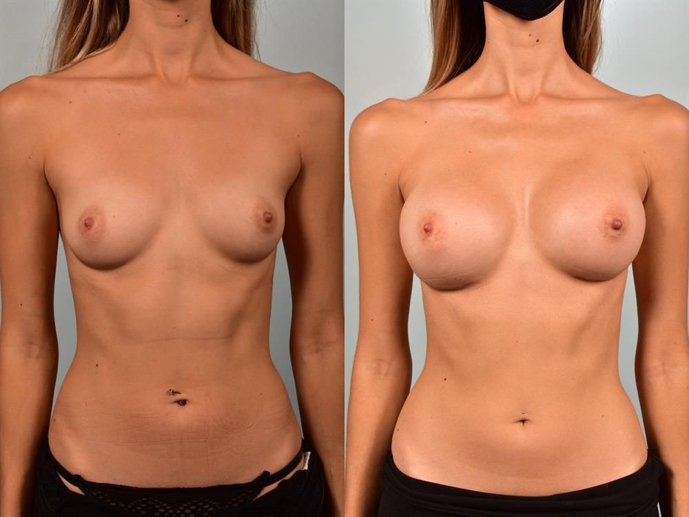 Breast Augmentation 287