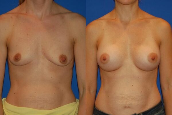 Breast Augmentation 288