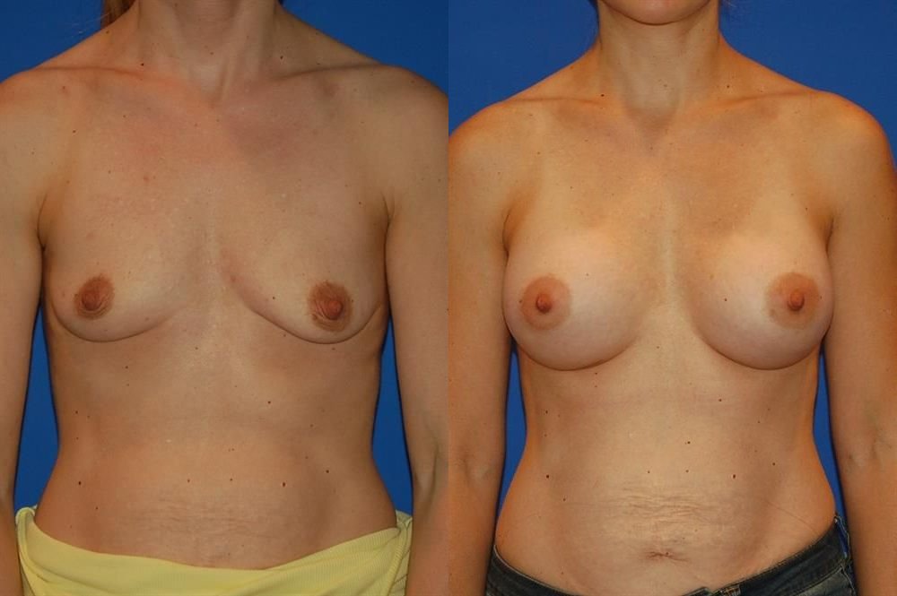 Breast Augmentation 288