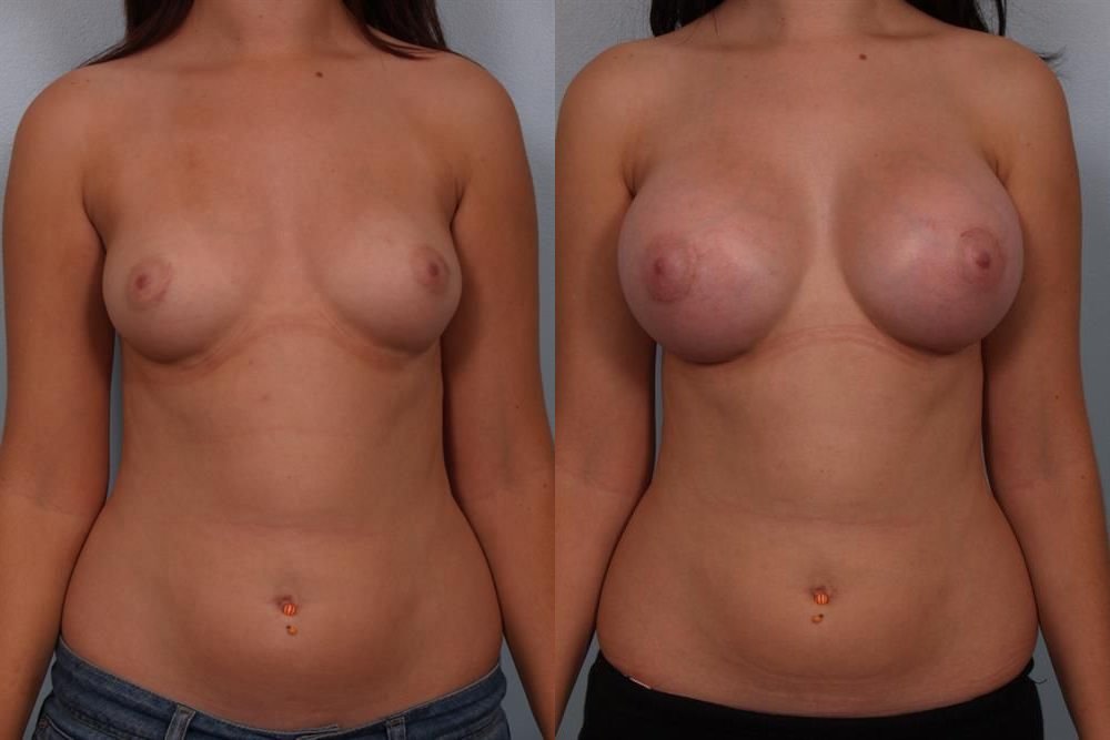 Breast Augmentation 289