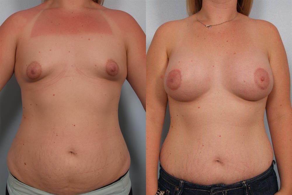 Breast Augmentation 290