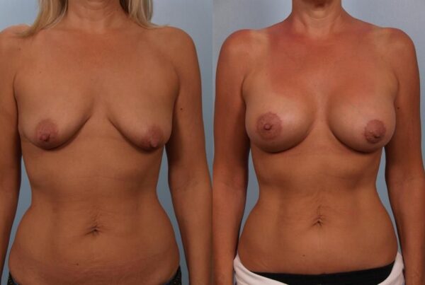 Breast Augmentation 291