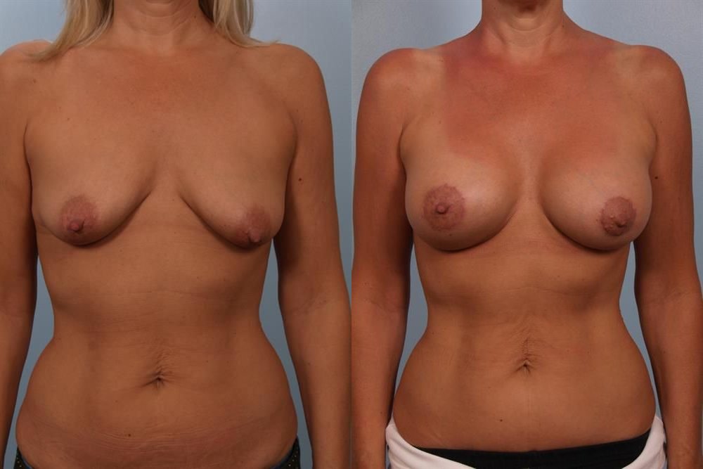 Breast Augmentation 291