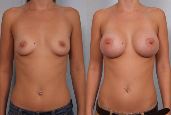 Breast Augmentation 292