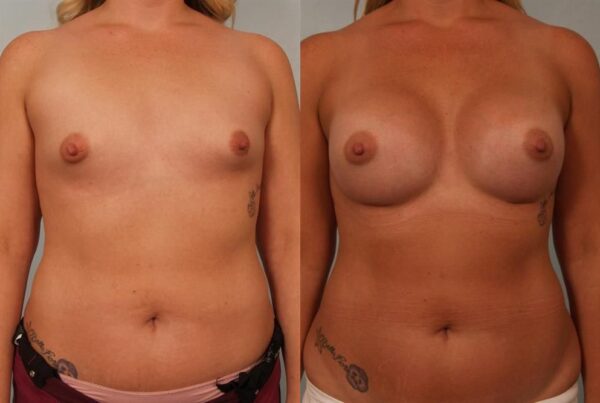 Breast Augmentation 293