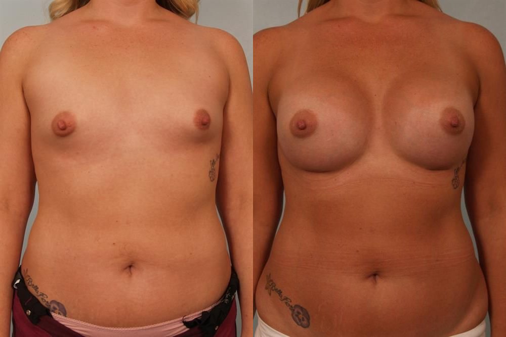 Breast Augmentation 293