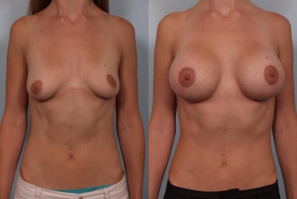 Breast Augmentation 294