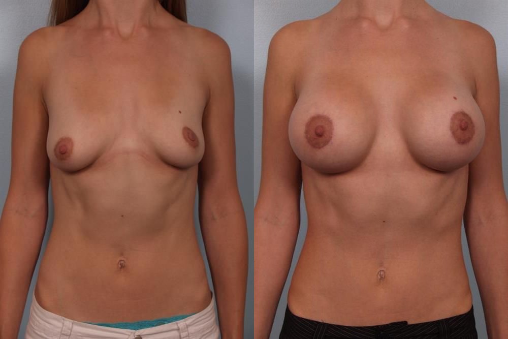 Breast Augmentation 294