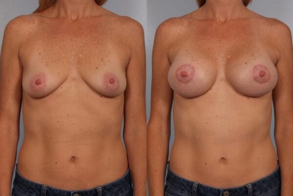 Breast Augmentation 295