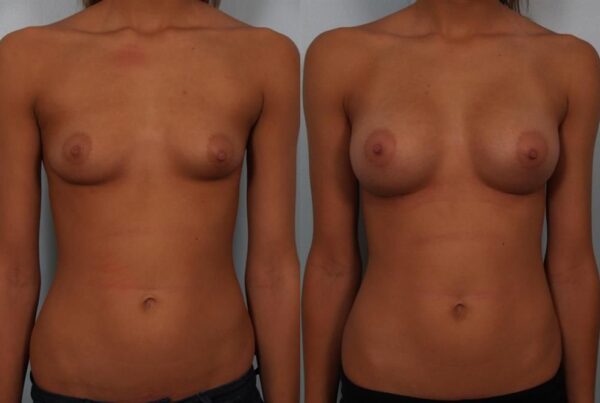Breast Augmentation 296