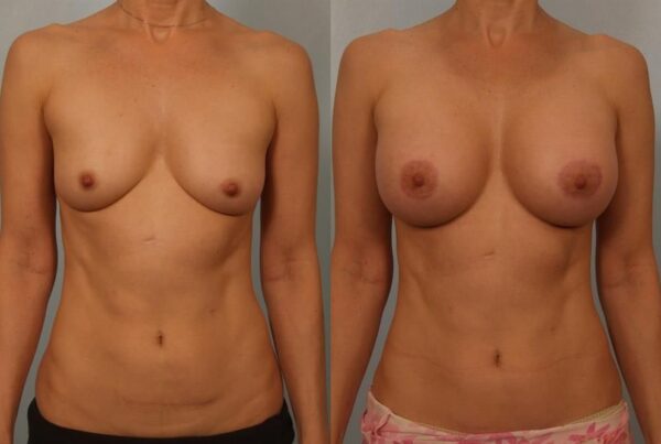 Breast Augmentation 297