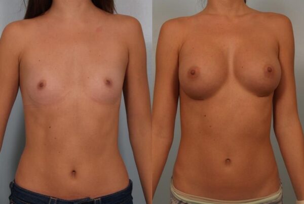 Breast Augmentation 298