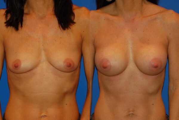 Breast Augmentation 299