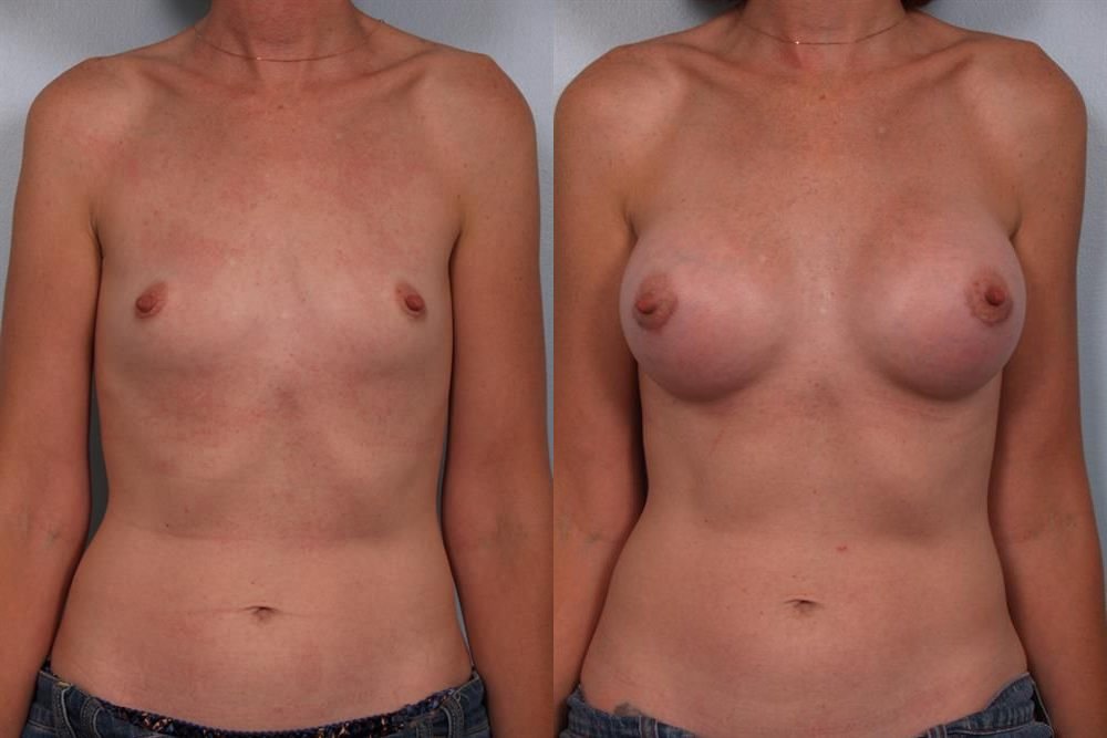Breast Augmentation 30