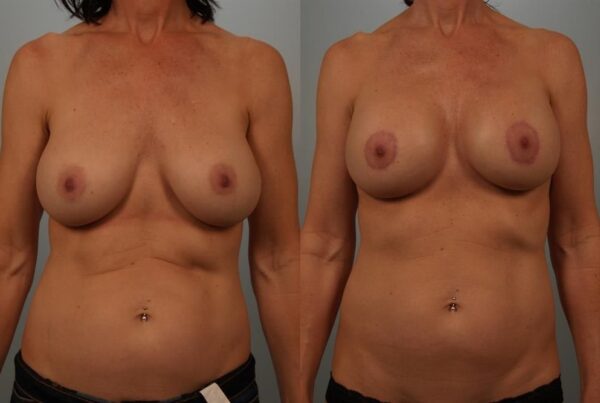 Breast Augmentation 300
