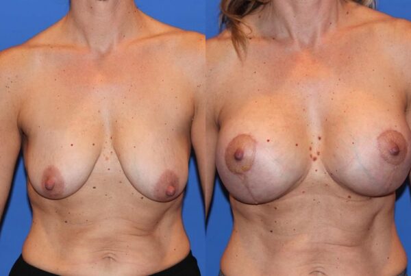 Breast Augmentation 301