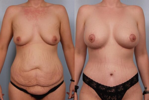 Breast Augmentation 302