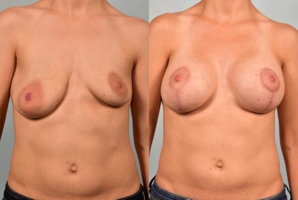 Breast Augmentation 303