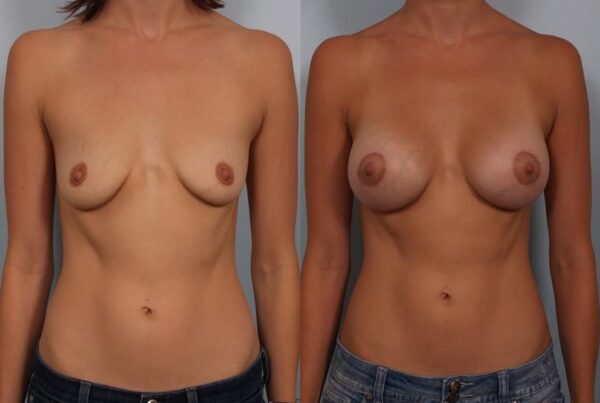 Breast Augmentation 304