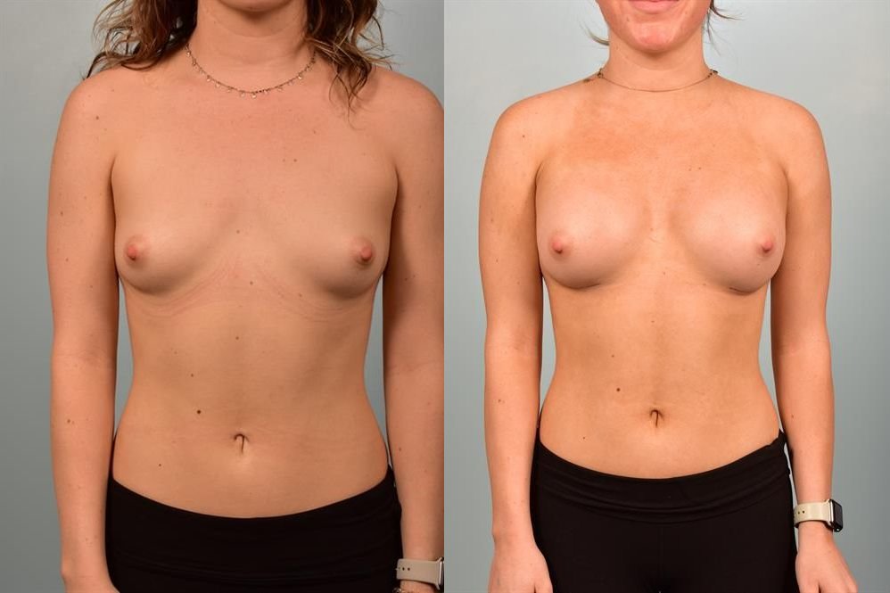 Breast Augmentation 31